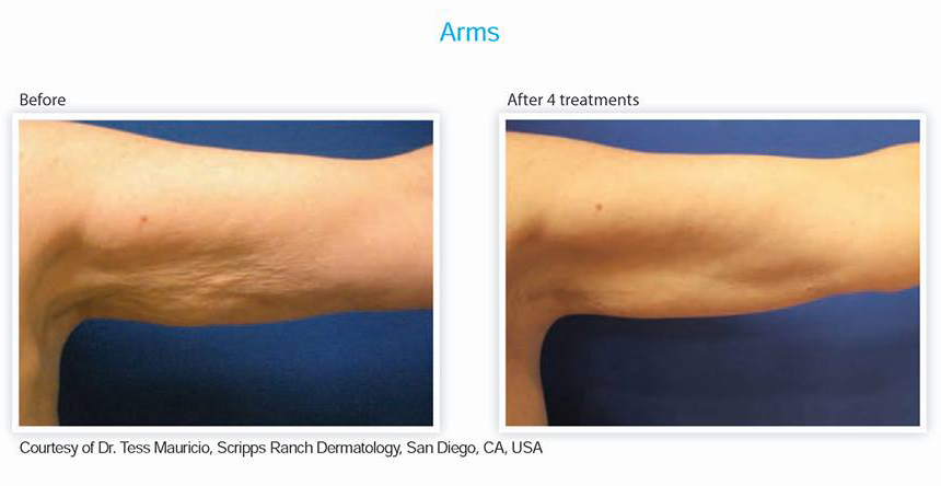 Arms Treatment