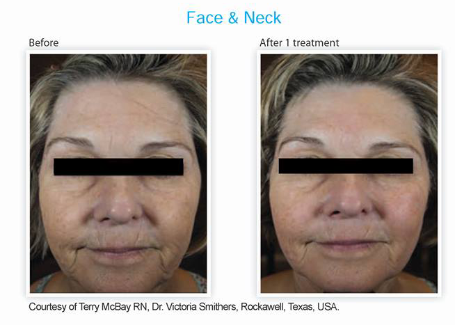 Face & Neck Treatment