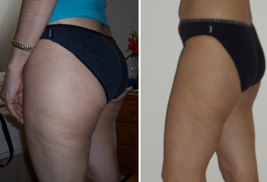 Buttocks & Thighs Treatment